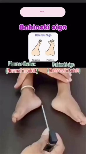 Dr.Niketa Bajaj on Instagram: "🧠✨ Neurology Made Simple! ✨🧠 Today we’re talking about the Babinski Sign – a simple but powerful neurological test! 👣 Plantar Reflex (Normal in Adults) → Toes curl downward ✅ 👣 Babinski Sign (Abnormal in Adults) → Big toe moves upward & other toes fan out 🚫 🔎 What does it mean? 👉 A positive Babinski sign in adults may indicate an issue with the central nervous system (brain or spinal cord). 💡 Fun fact: In babies, a positive Babinski sign is normal up to 1 y