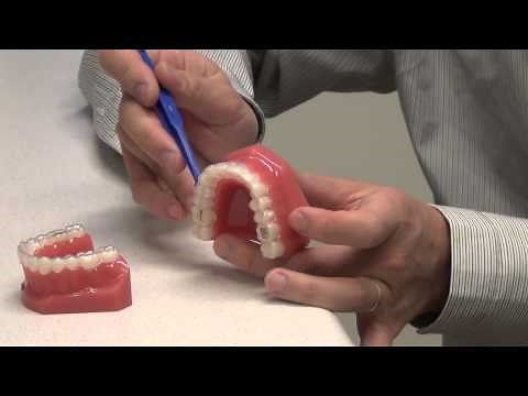 Making orthodontic treatment easier- Removing Invisalign aligners with the aligner removal tool