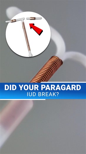 ⚖️ Did your Paragard IUD break during removal? If so, you may qualify for compensation. Thousands of women have come forward to file claims. Get a free case review today to determine your eligibility. | Paragard Lawsuit Claim Help