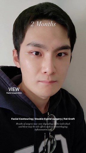 Achieving the Perfect K-Pop Look Through Plastic Surgery