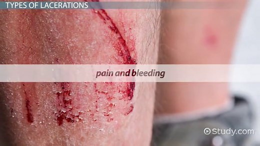 Laceration | Definition, Types & Treatment