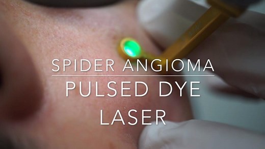 Treatment of a spider angioma with the pulsed dye laser