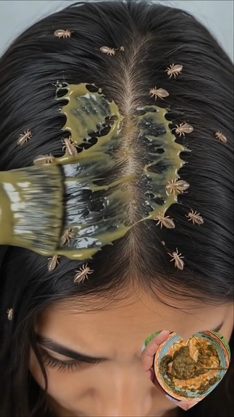Help keep your scalp fresh and clean with this simple homemade head lice care. 🍃✨#HeadLice #ytshorts