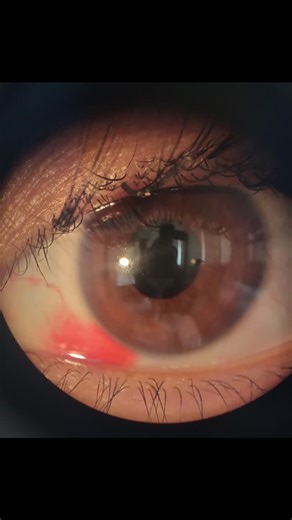 Theia Eye Care Clinic on Instagram: "Fake eyelashes?? Yes, they can cause big eye problems if not used with caution and care. This patient suffered from Subconjunctival haemorrhage after rubbing the eye where the artificial eyelash was turned inwards. . Don't take your eyes for granted 🙏 You can do eye make up but make sure you handle your Eyes with care 😊 . For any eye related problem, contact us on +91-8851560068 or log onto theiaeyeclinicdelhi.com . #fakeeyelashes #trauma #bleeding #theiaey