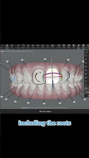 How Invisalign works: An orthodontist’s smile design modification using Clincheck software. 2023