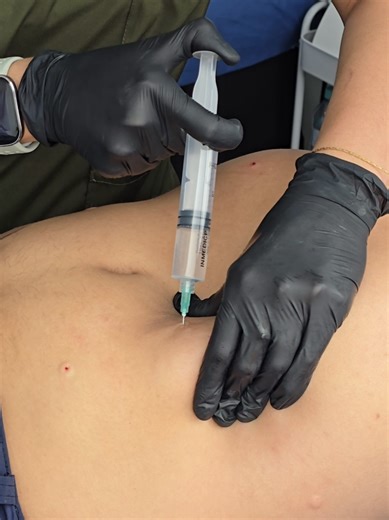 Reduce medidas sin cirugía con Hidrolipoclasia 👩🏻‍⚕️ #reducemedidas #hidrolipoclasia #esteticacorporal #medicinaestetica #fyp