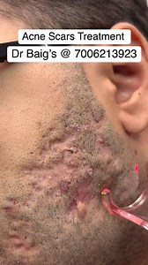Acne scars Treatment by Laser at Dr Baigs Clinic. 7006213923 Laser treatment for acne and scars is a non-invasive cosmetic procedure that uses focused light energy to target and improve skin texture. It works by stimulating collagen production, reducing inflammation, and resurfacing the skin. #acnescars #acne #skincare #acnetreatment #skincareroutine #microneedling #glowingskin #skin #skincaretips #hyperpigmentation #beauty #clearskin #antiaging #acneskincare #acneproblems #acnescarsremoval #fac