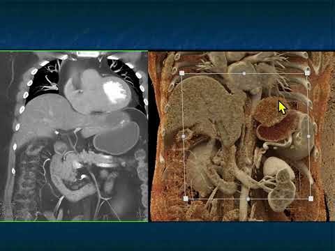 CT Evaluation of Hepatic Masses: A Focused Approach to Signs and Enhancement Patterns - Part 3