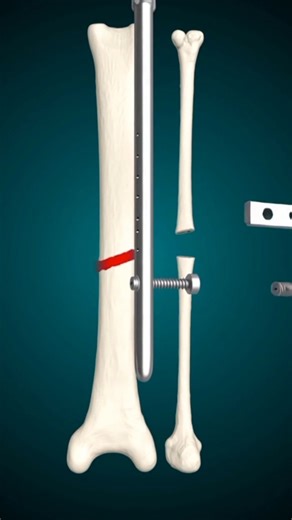 Tibia Fibula Bone Surgery || Tibia Fibula Femur & Other Fracture Recovery || The Road To Recovery