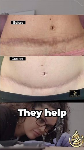 👍 How to Improve Tummy Tuck Scars | Camouflage Tattoo