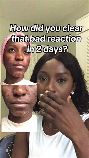 Fix Your Skin Reaction with Ketoconazole Cream