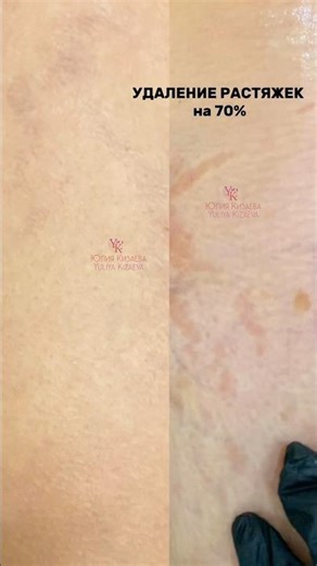 Удаление растяжек на 70% методом fibroblast, до/после