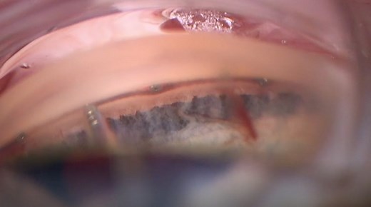 Interventional Glaucoma: iStent Infinite and iDose - Eyetube
