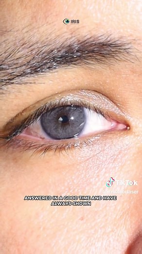 Dany's Eye Color Transformation Experience at Iris Color Laser