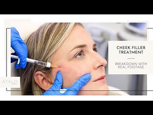 Cheek Filler Treatment Breakdown!