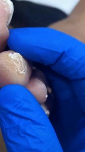 Removing Tip of toe callus debridement . . . #footpain #plantarfasciitis #heelpain #podiatry #footcare #podiatrist #orthotics #feet #foothealth #kneepain #foot #running #anklepain #backpain #bunions #flatfeet #healthyfeet #footpainrelief #arthritis #health #footdoctor #bunion #painrelief #insoles #sportsinjury #physicaltherapy #flatfoot #footsurgery #shoes #mortonsneuroma | Docpods Treatment