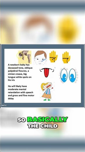 Down Syndrome Newborn: Early Signs & What To Look For #shorts