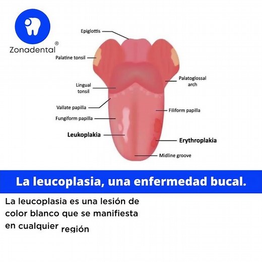 La leucoplasia, una enfermedad bucal.