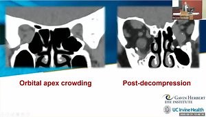 Thyroid Eye Disease: Overview, Signs, Symptoms and Management