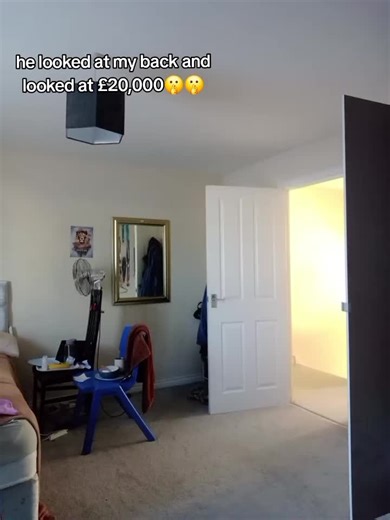 pros of having spinal fusion #fyp #spinalfusion