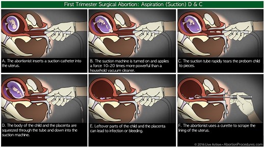 Abortion Facts - Pro-Life Future