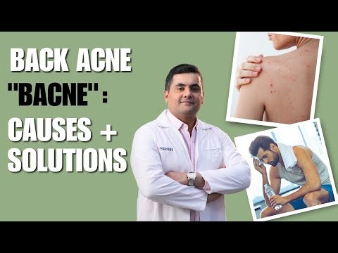 Back Acne: Causes + Solutions. 🧑🏻‍⚕️