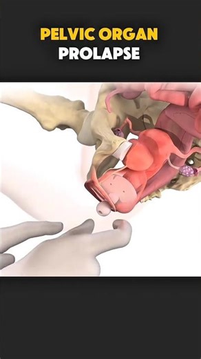 Medical universe 3dPelvic Organ Prolapse (3d Animations) “Pelvic organ prolapse is more common