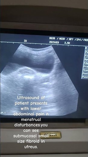 submucosal fibriod#ultrasound #gynae#shortfeeds