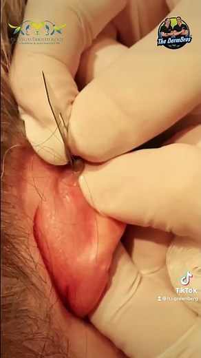 Dr. H.L. Greenberg Incises & Drains a Post Auricular Cyst at Las Vegas Dermatology
