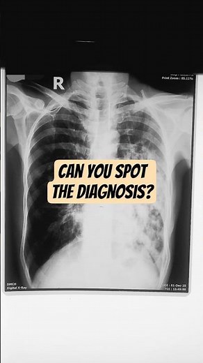 Can You Spot the Diagnosis? Patchy Opacity with COPD Findings | Chest X-ray #shorts