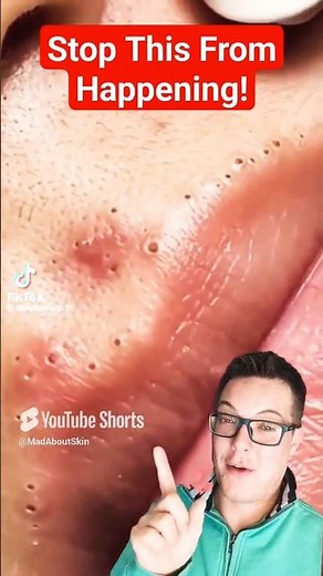 ⚠️ STOP THIS HAPPENING - Crazy Lips Blackhead Removal #shorts