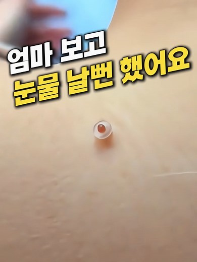 👆프로필 메인오시면 링크에서 구매가능해요. (상품번호178번) #쥐젖제거 #사마귀제거 #쿠팡추천템