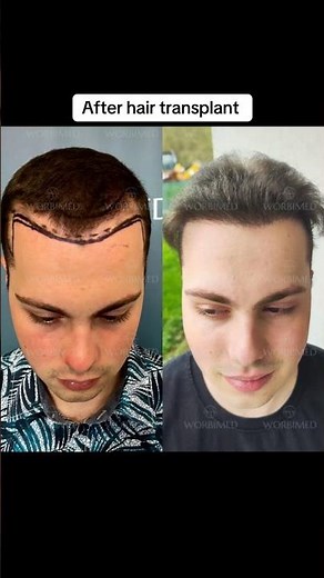 Hair transplant in Turkey | Before and after hair transplant #hairtransplant