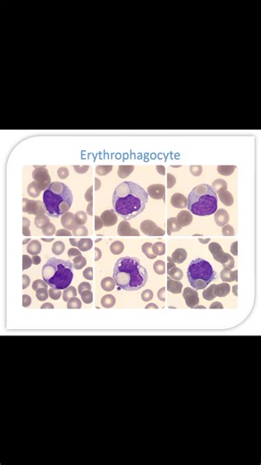 Rose Apple on Instagram: "🌸Erythrophagocytosis 🌸 🌸the process by which phagocytic cells, such as Macrophages or Monocytes, engulf and digest senescent or abnormal red blood cells. 🌸Mechanism and Key Functions ✅ Physiological clearance: Under normal conditions, Erythrophagocytosis occurs primarily in the spleen, liver, and bone marrow, where aged red blood cells (with a lifespan of approximately 120 days) are removed. ✅ Iron recycling: This process allows the recovery of iron from hemoglobin,