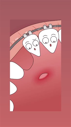 Impacted maxillary canines: Open vs Closed surgical exposure Systematic reviews and the Cochrane review report no consistent superiority of open or closed exposure for overall success, periodontal outcomes, aesthetics, or treatment duration (evidence quality often low/very low). (Parkin et al., 2017; Cassina et al., 2018; Sampaziotis et al., 2018) OPEN exposure Pros: • Direct visibility and easier monitoring/hygiene • No second-stage uncovering Cons: • Aesthetic inconvenience during traction • R