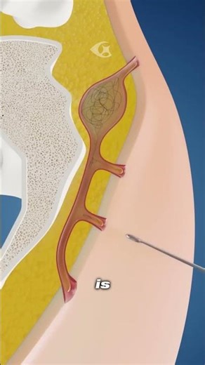 What is a pilonidal cyst?