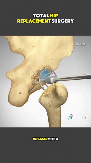 Total Hip Replacement: 3D Animation Explained
