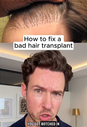 Fixing a Failed Hair Transplant: Expert Tips