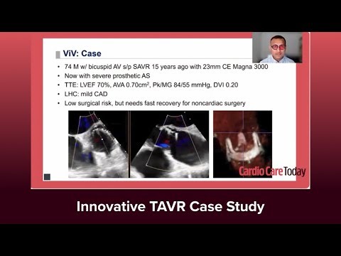 Valve-in-Valve TAVR for Rapid Recovery: A Case by Dr. Amit Goyal