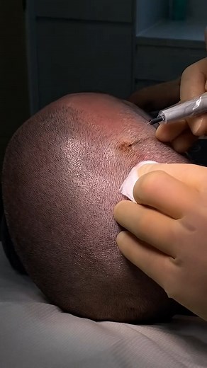 Quick and Painless Mole Removal 😄 #moleremoval #skincancerawareness #molecheck #plasticsurgery #ukskin | UK SKIN