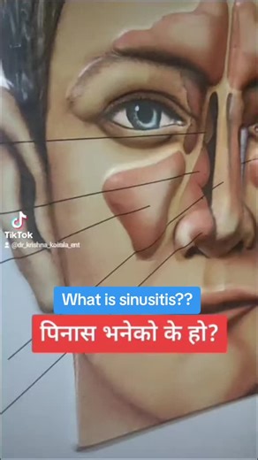 Understanding Sinusitis: Symptoms and Treatments