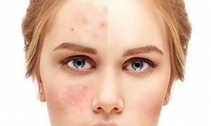 Treatment for Acne Scars and Scarring | APDerm