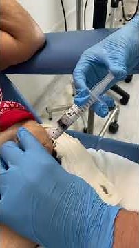 Aplicação subcutânea de Azacitidina em uma paciente de Mielodisplasia