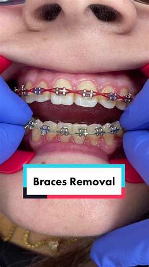 Getting your braces off soon? Watch our Braces removal process 💎 #bracesoff