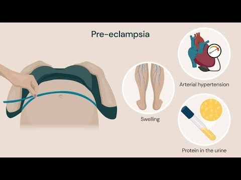 Eclampsia as an obstetrics emergency