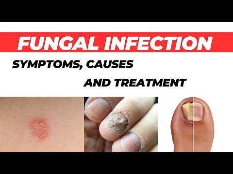 Fungal Infection: Symptoms, Causes, and Treatment | How to Cure Fungal Infection