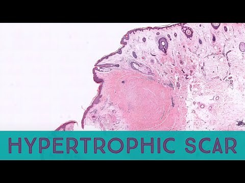 Hypertrophic scar under the microscope with injected kenalog steroid -pathology dermpath dermatology