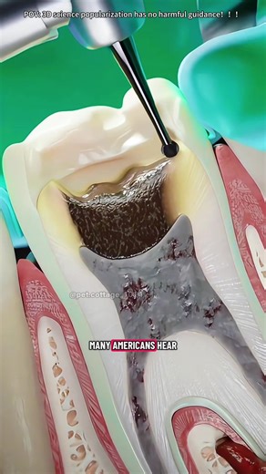 Understanding Root Canal Treatment: Process and Recovery