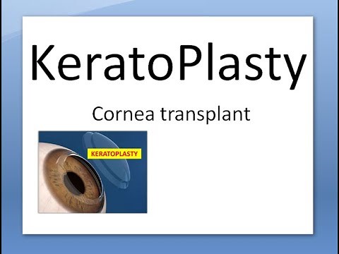 Ophthalmology 145 a Keratoplasty Cornea Transplant Eye donation Donor Surgery Indication Type Define