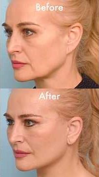 I Got a Deep Plane Facelift at 50 – Before & After at 1 Month